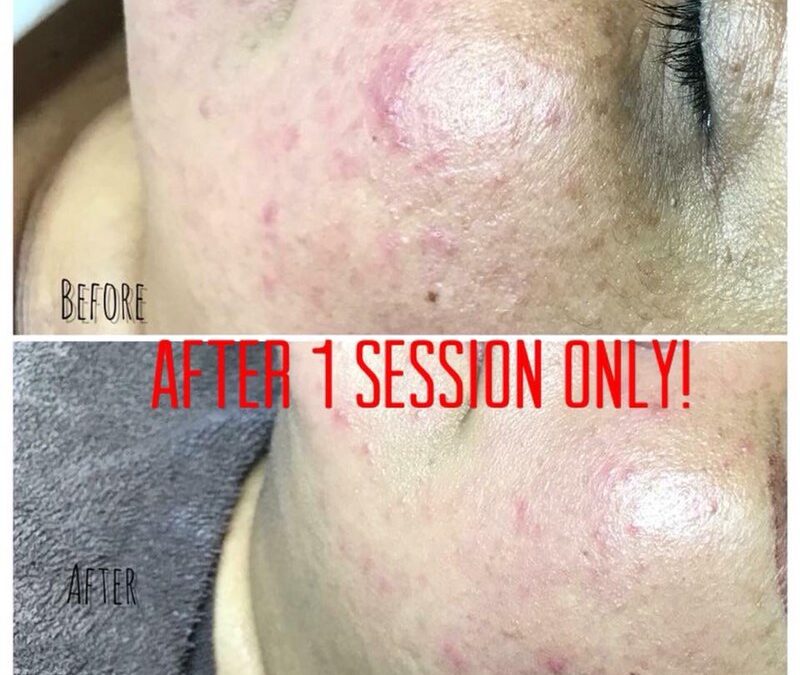 What Is Microdermabrasion?