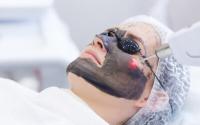 Why Carbon Laser Facials Are Summer’s Best Kept Skin Secret